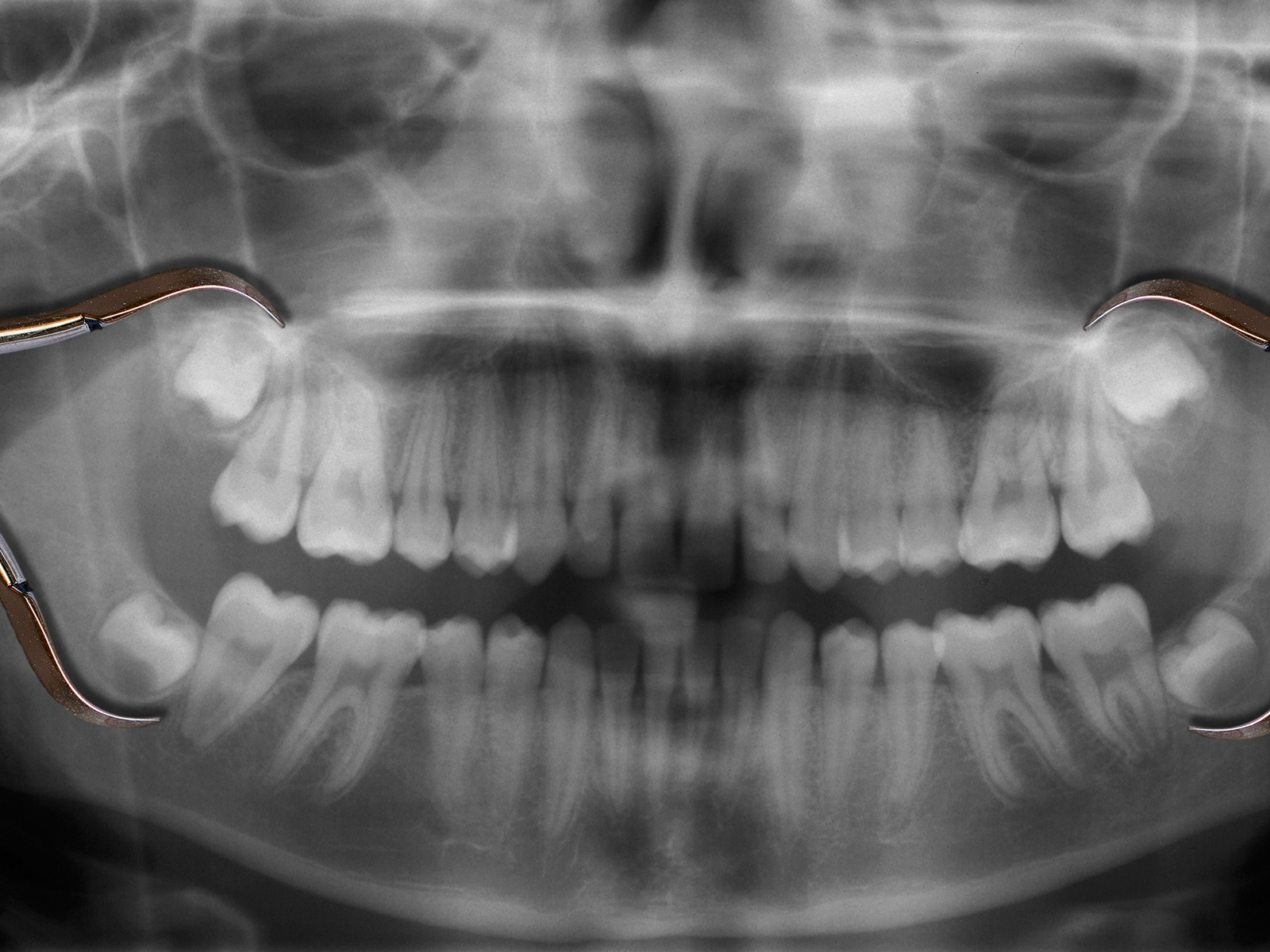Do Wisdom Teeth need to be Removed?