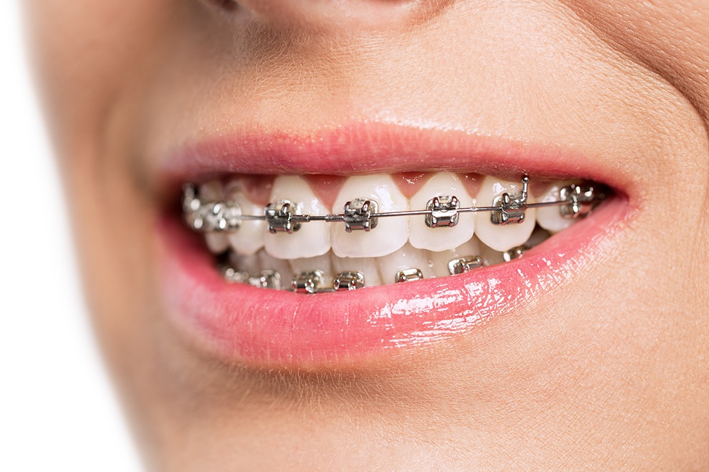 Do Braces Fix Overbite 