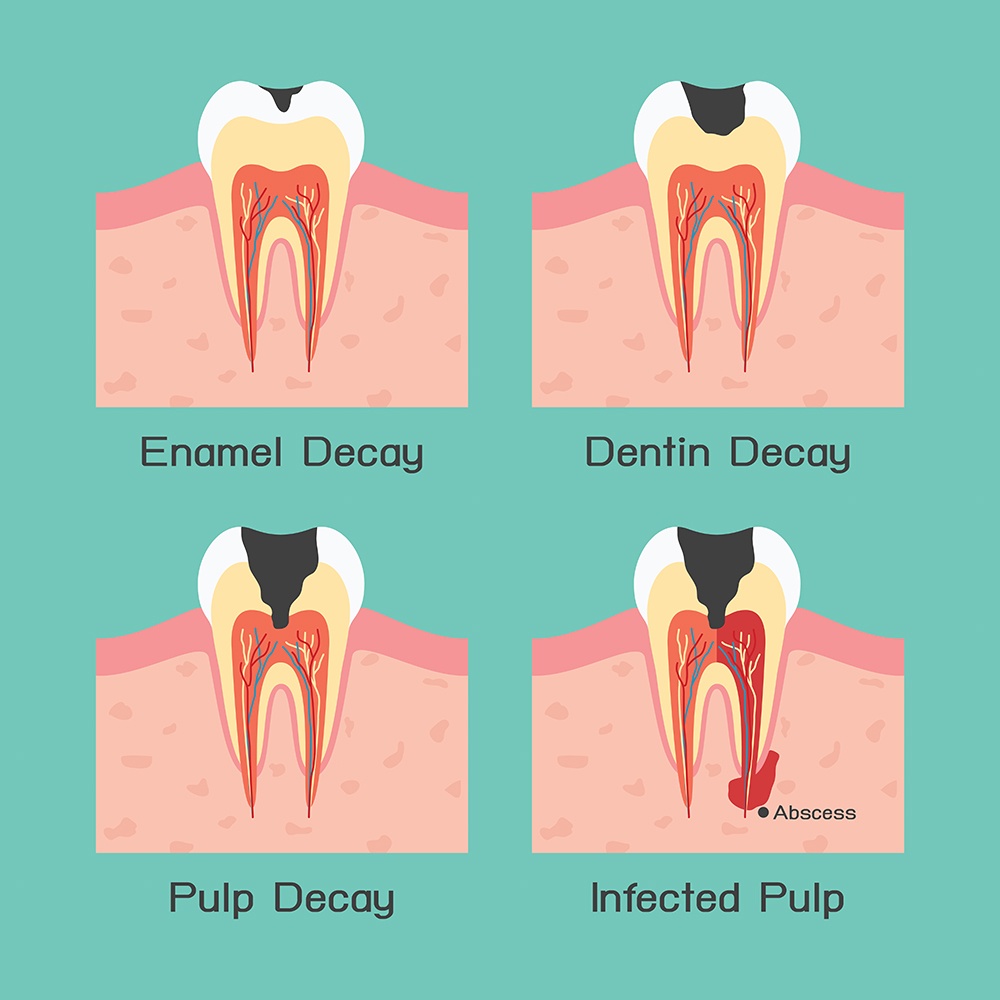 tooth root