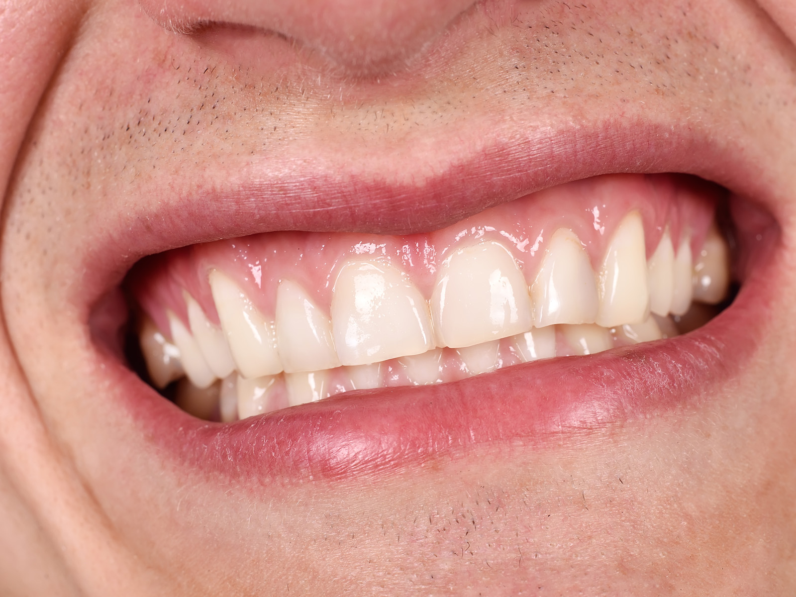 Gum Graft: What All You Should Know