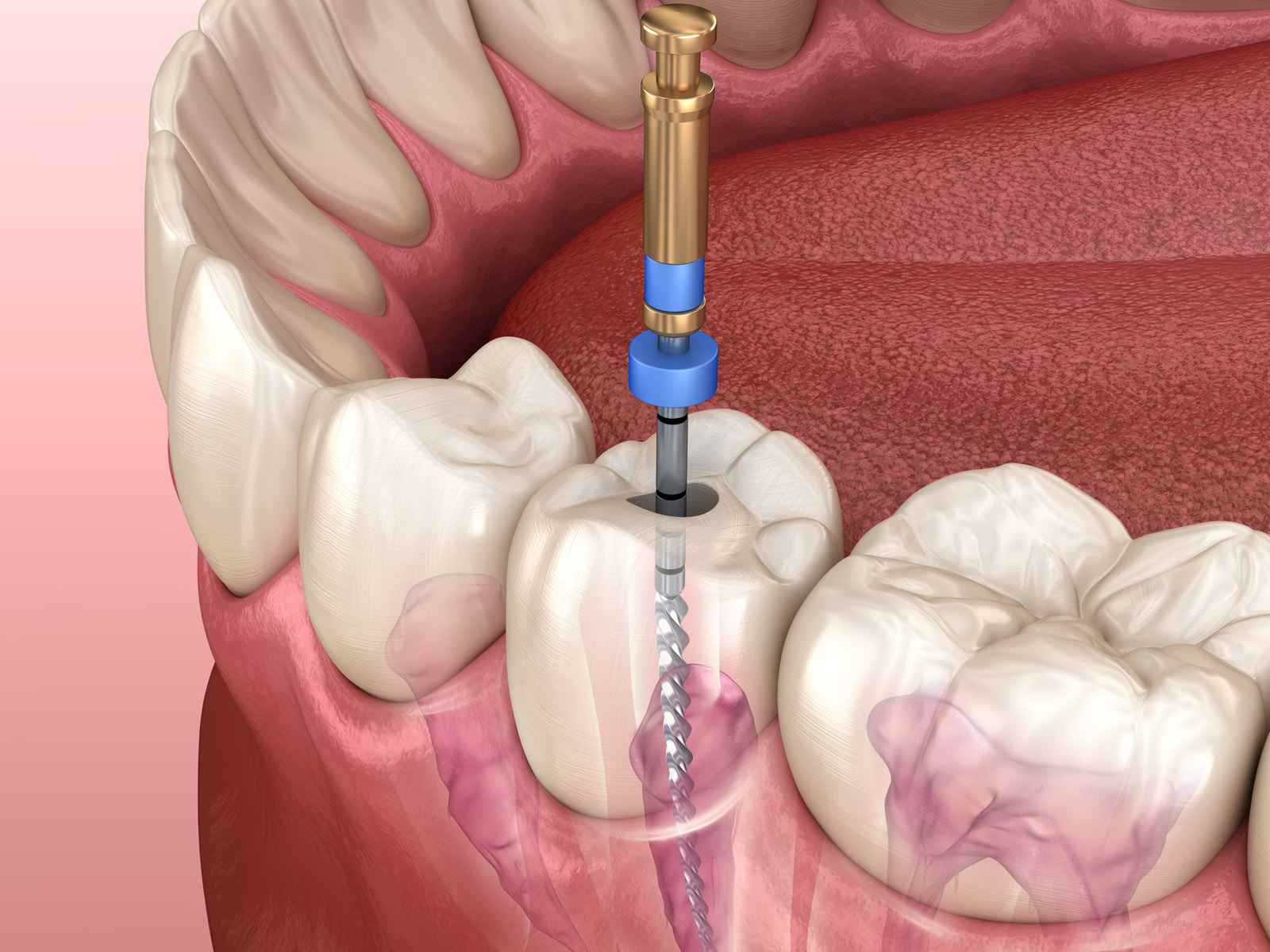 What are the Alternatives to Root Canal Treatment?