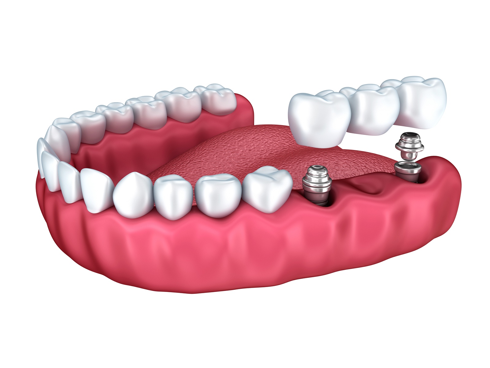 Can you get dental implants with gum recession?