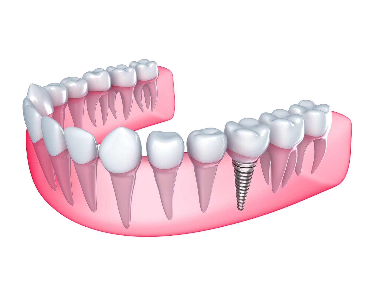 How long after an implant can I get a crown?