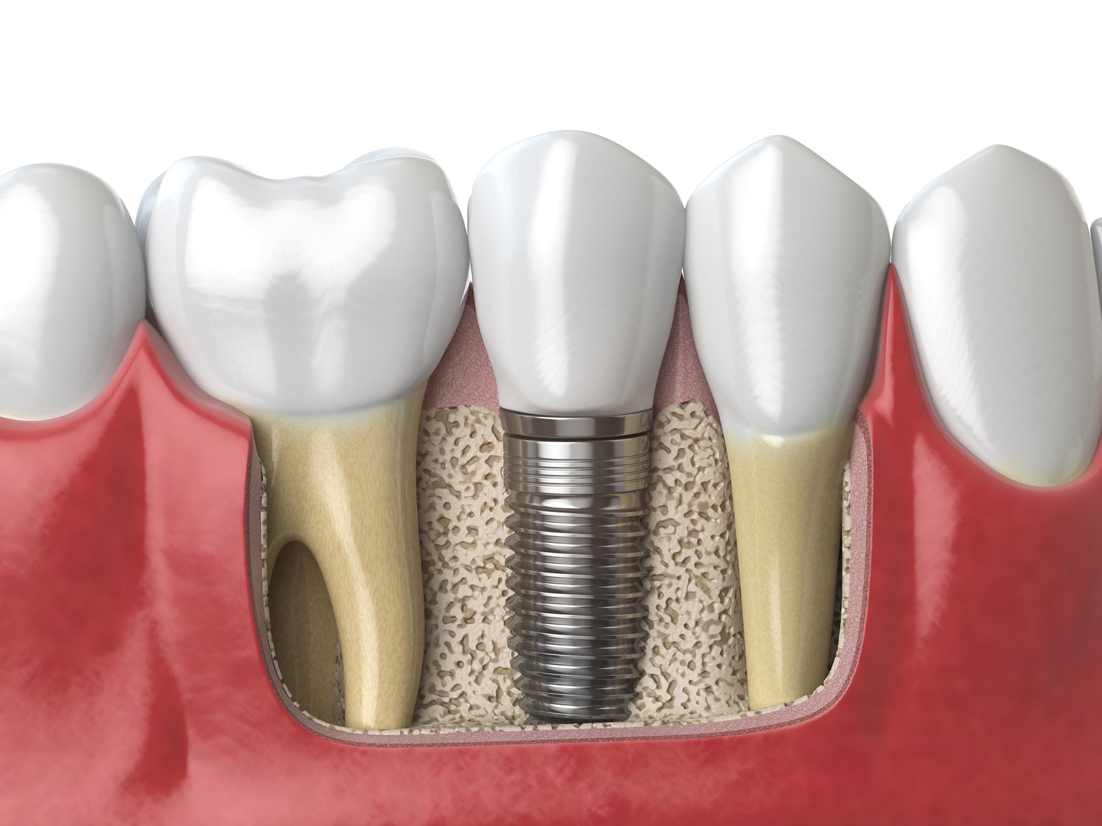 What Are The Pros and Cons of The Implant?