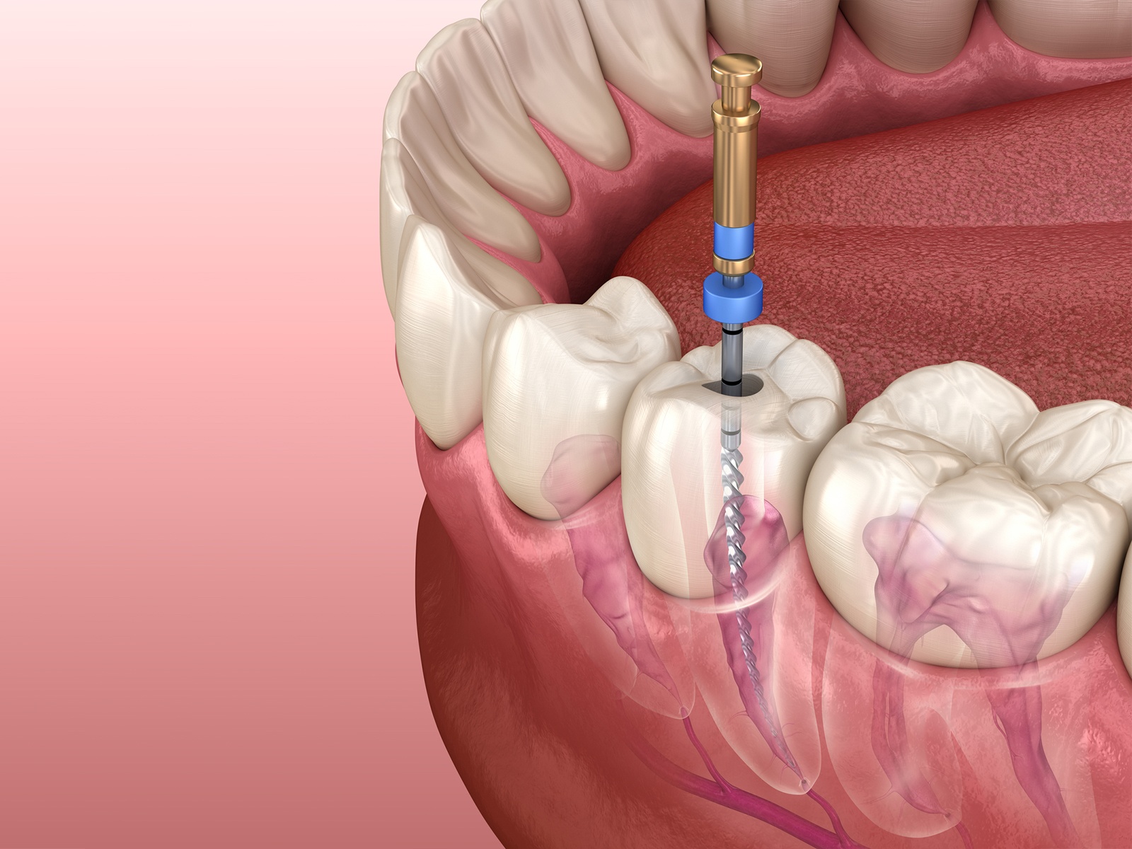 Can Amoxicillin Treat Root Canal Infection?