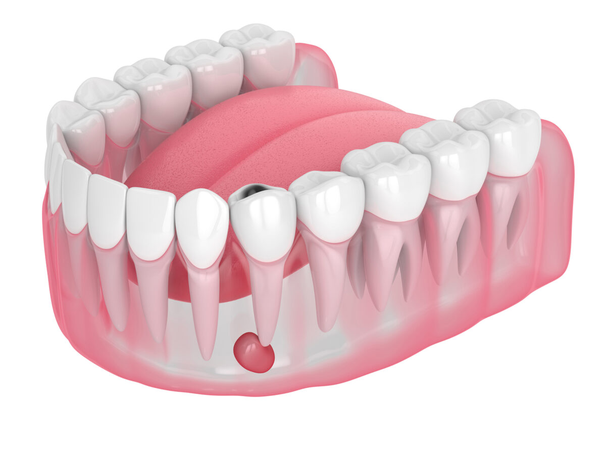 tooth abscess