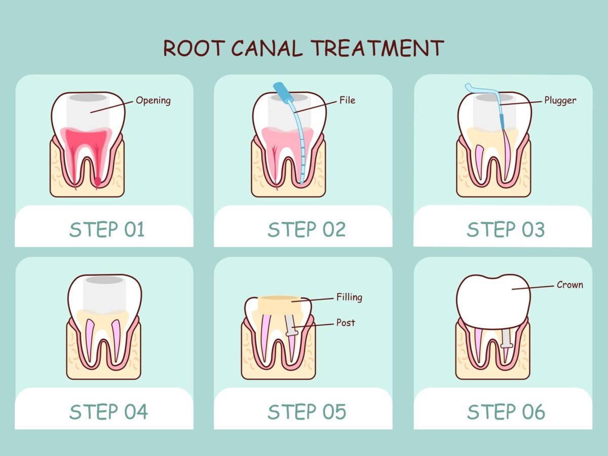 root canal recovery