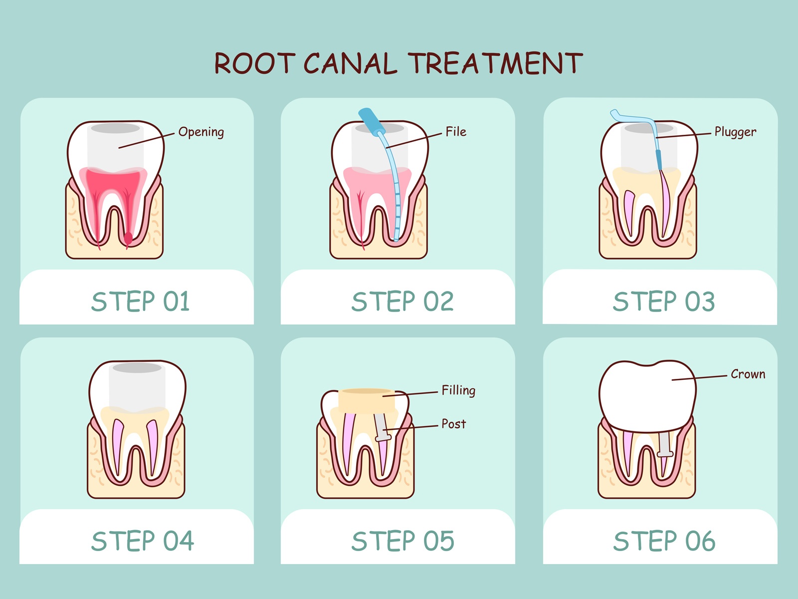 How long is root canal recovery?