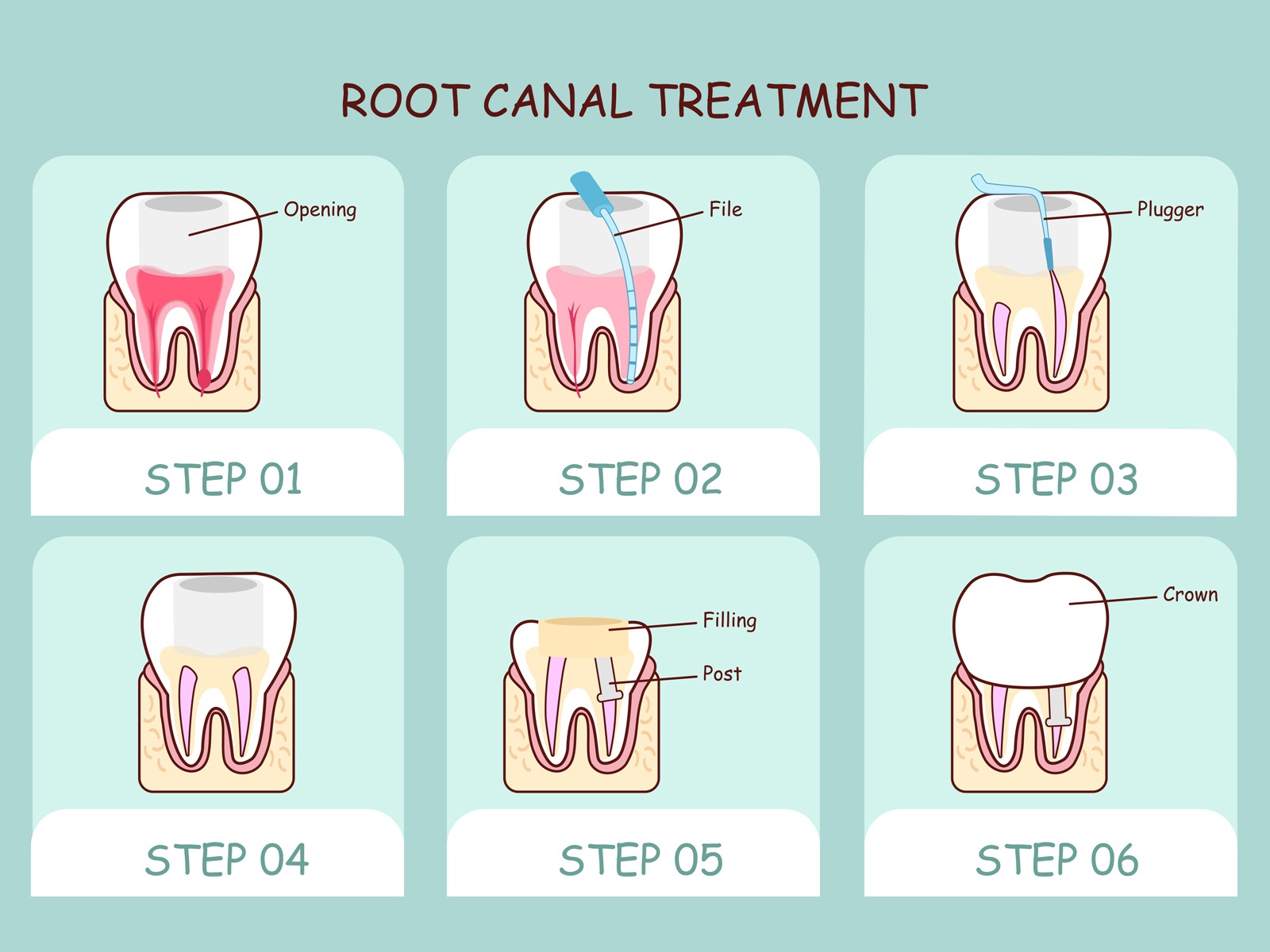 Root Canal Recovery Time