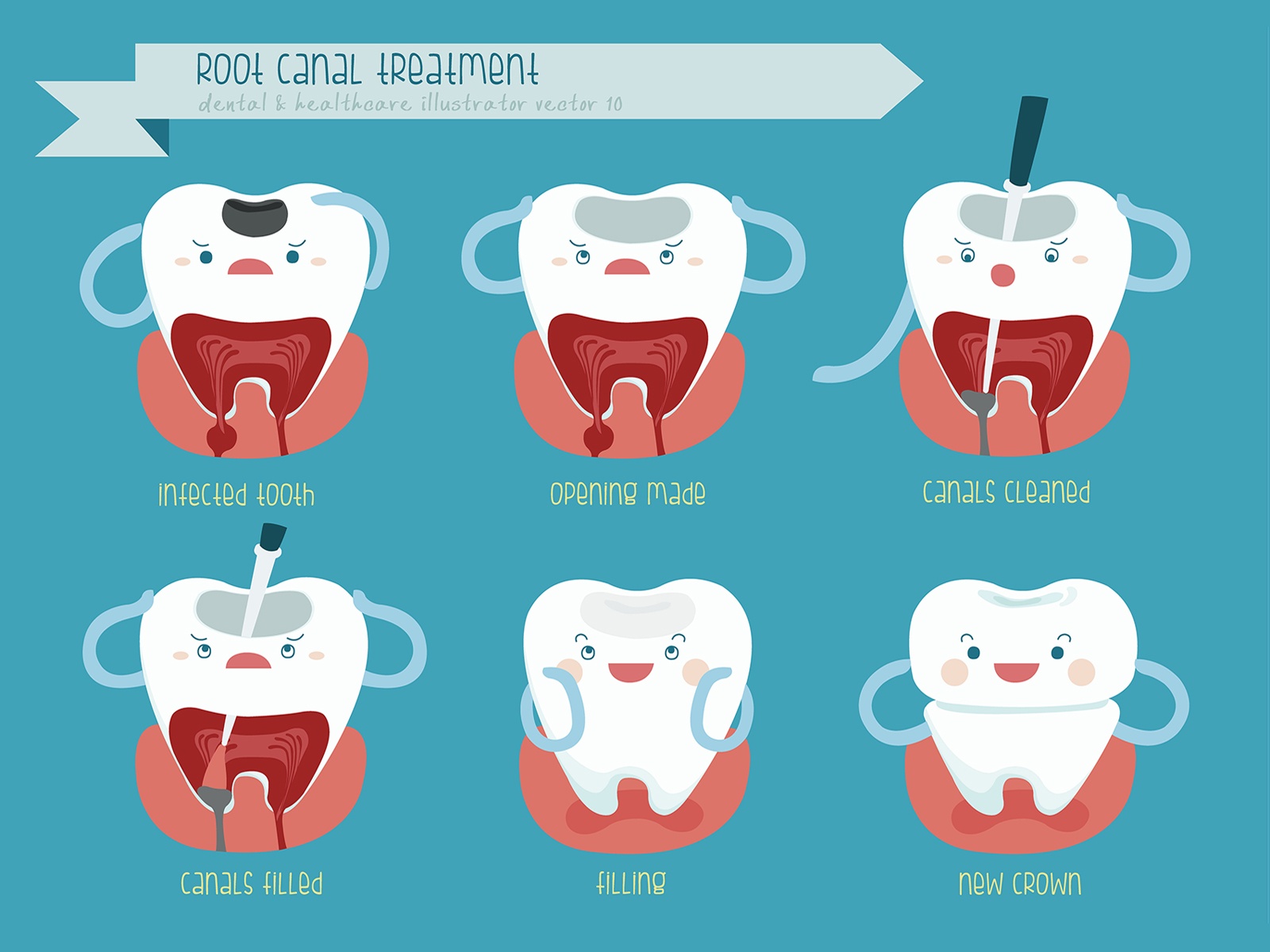 Can You Get a Filling Instead of a Root Canal?