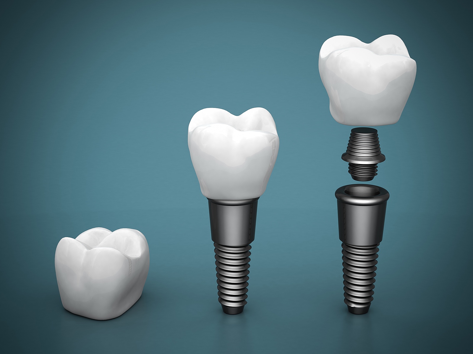 How do you clean dental implant abutment?
