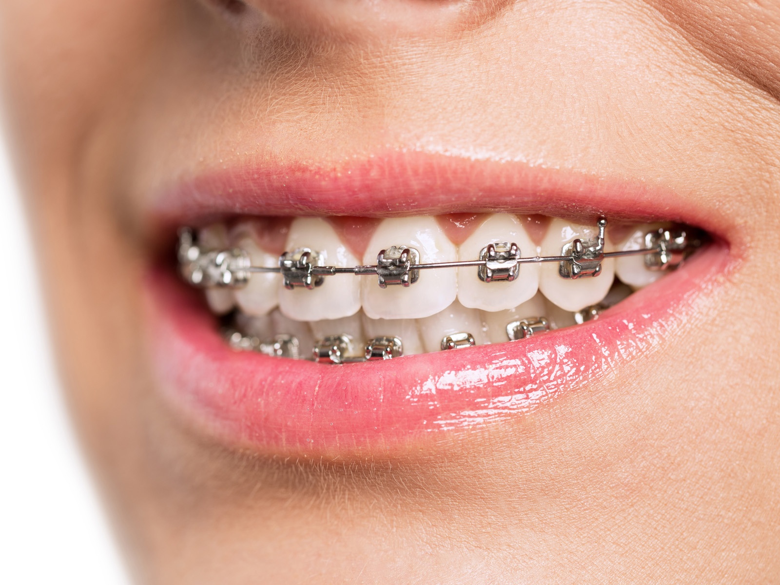 Do braces make your breath stink?