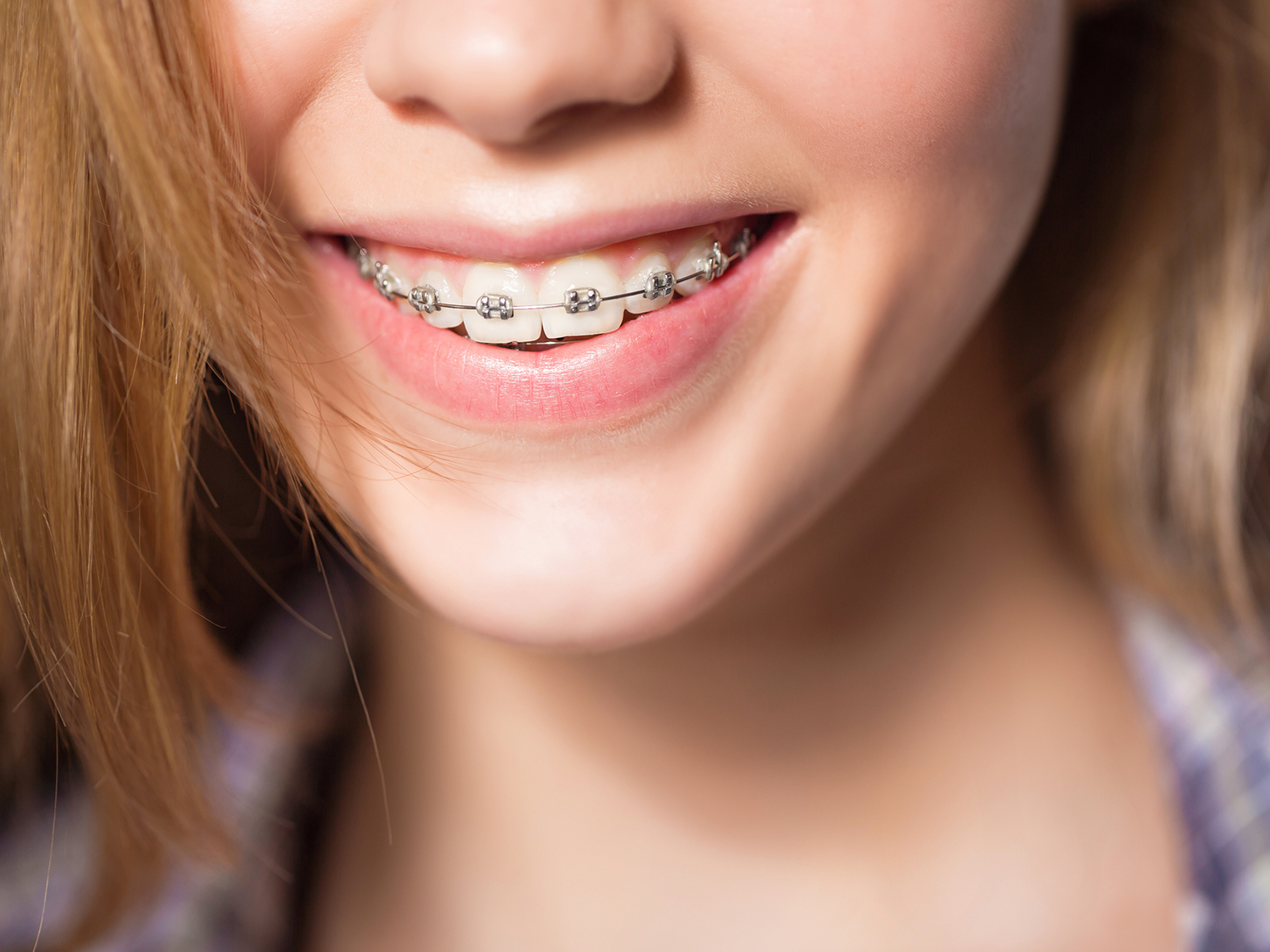 What is the best type of braces?