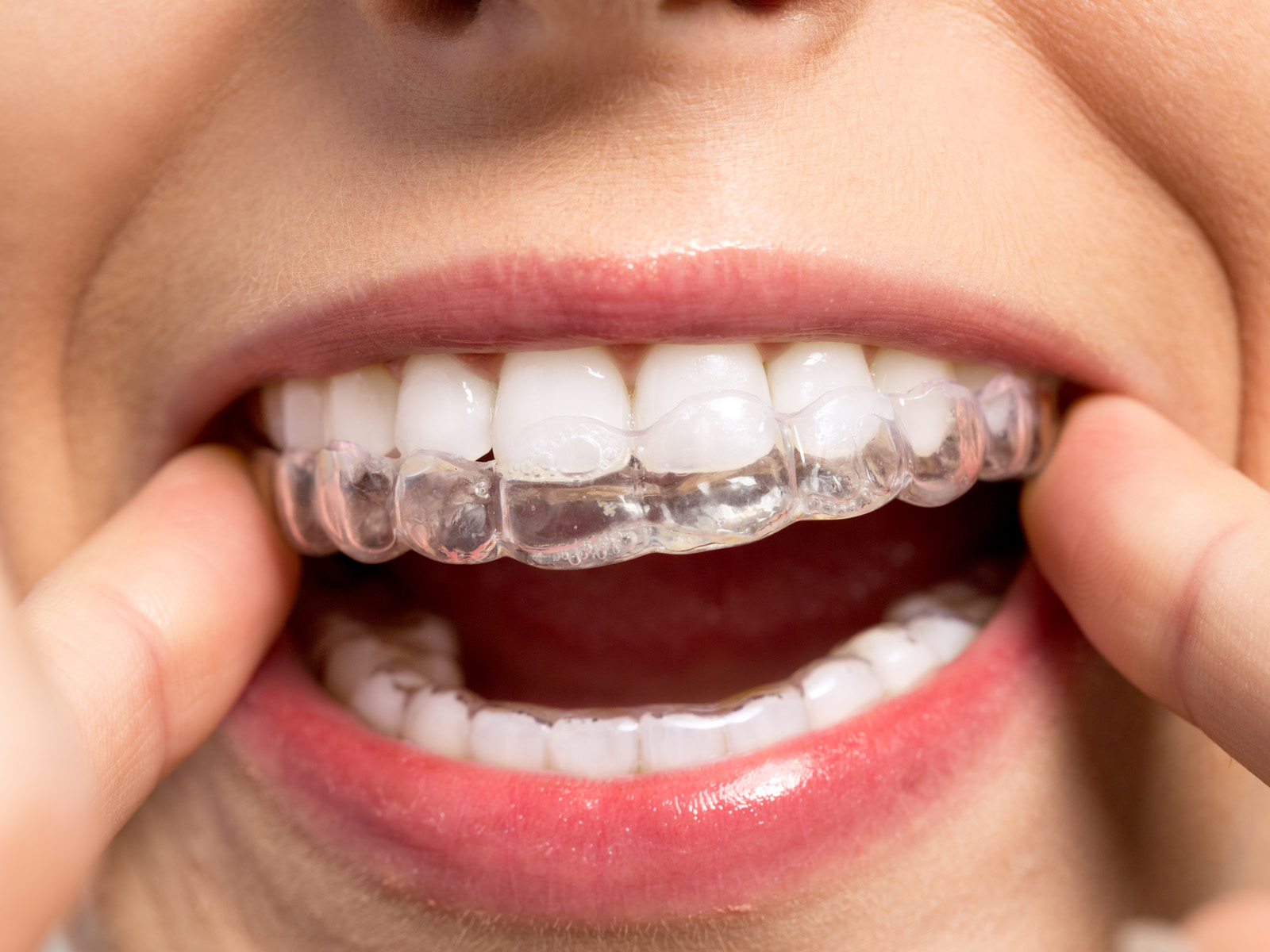 Can Invisalign fix really crooked teeth?
