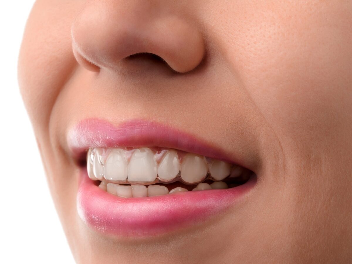 Invisalign aligners