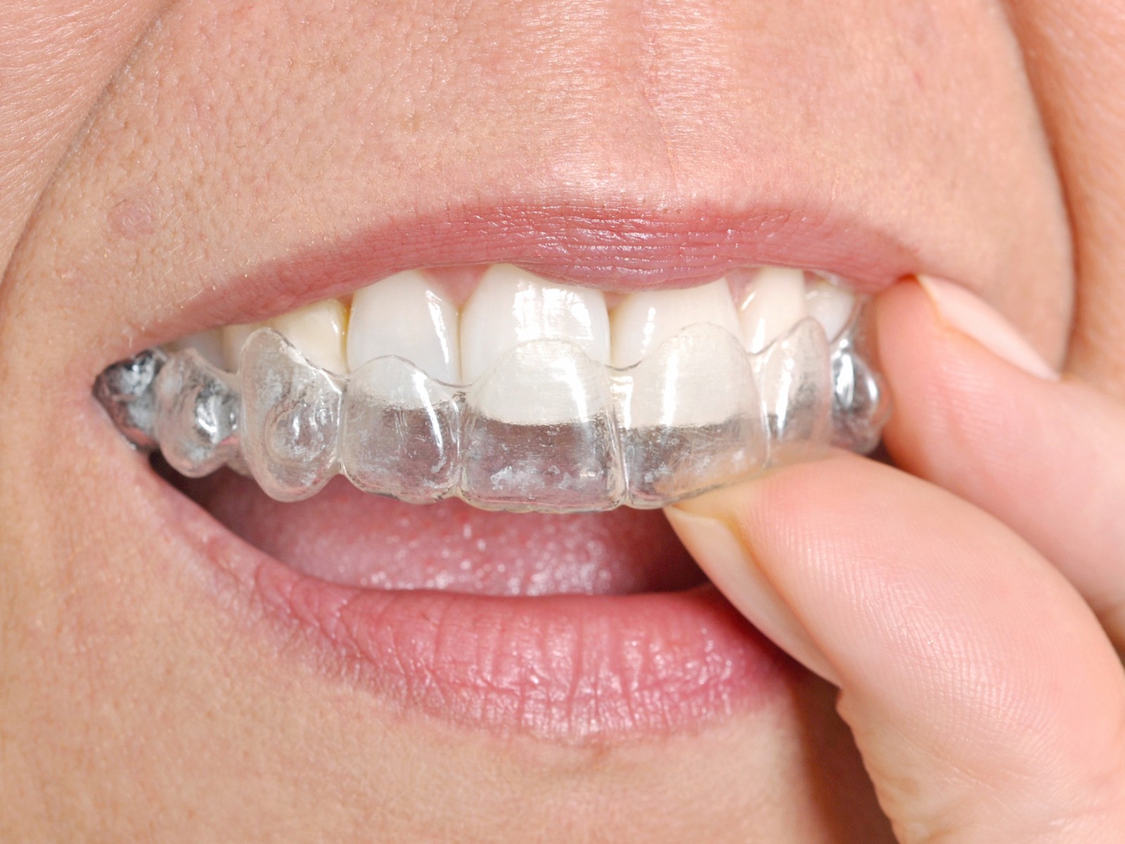 What is the last stage of Invisalign?