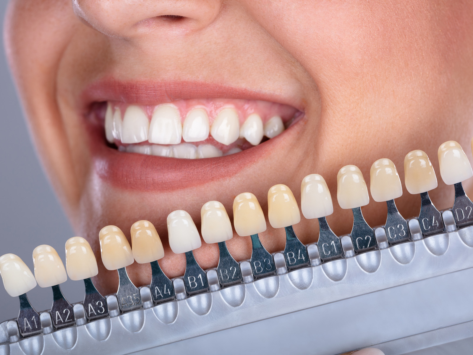 Are There Different Types of Veneers?