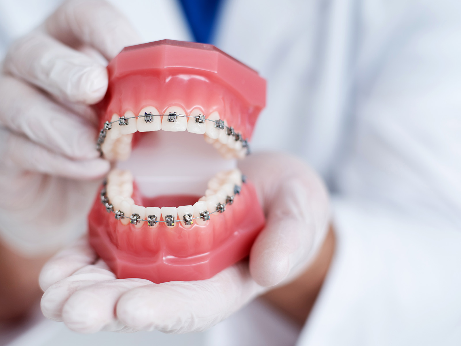 What are damon braces and how are they different from regular braces?