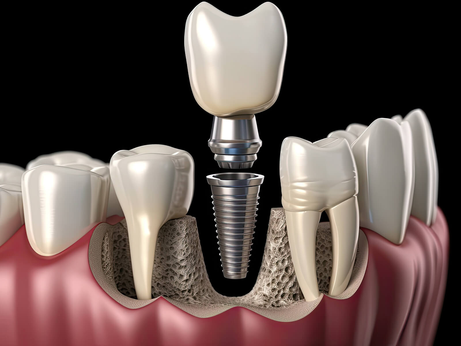 Ensuring the Endurance of Your Dental Implants: Key Aftercare Strategies