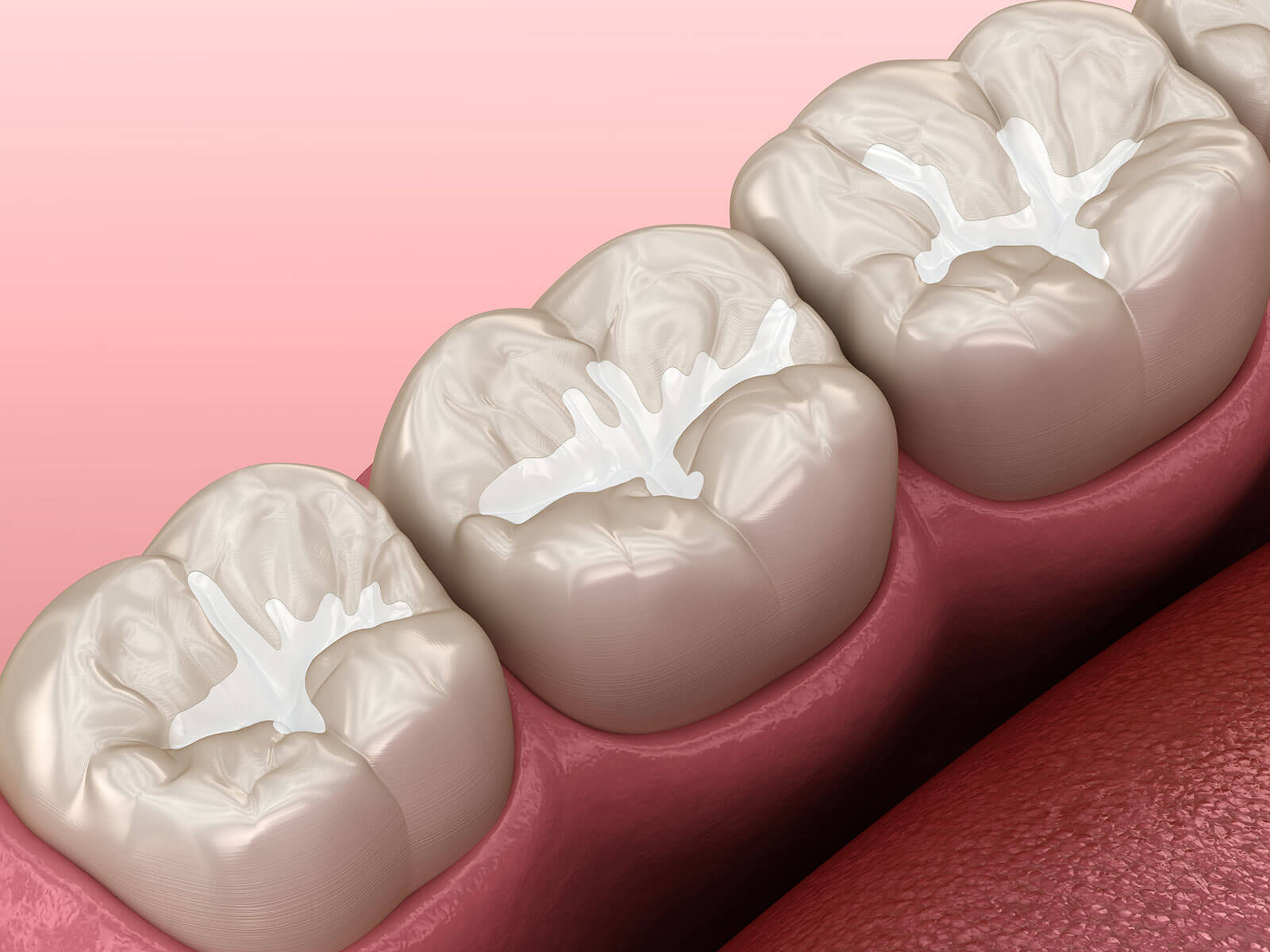 The Role of Sealants In Preventing Tooth Decay