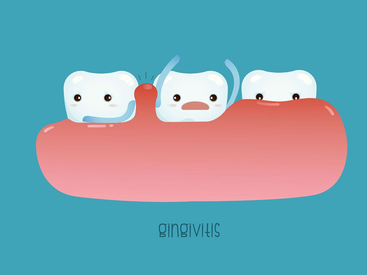 How to Recognize and Treat Gingivitis: Symptoms and Causes