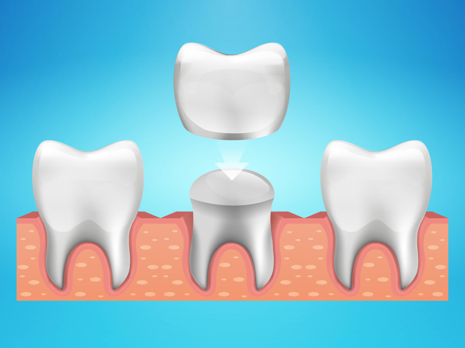 5 Reasons You Might Need A Dental Crown