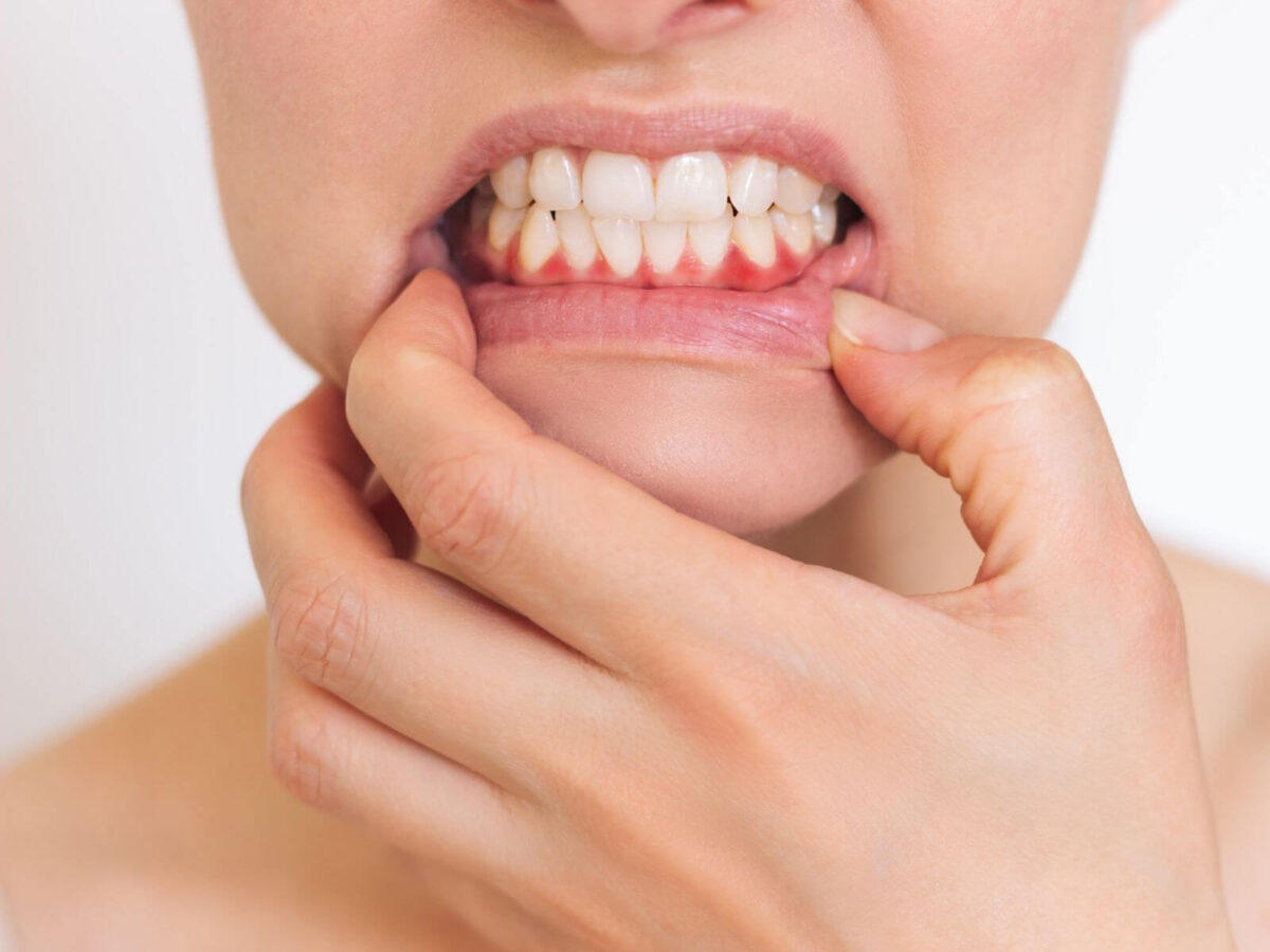 Dark Gums Remedies: How To Lighten And Restore Gum Health