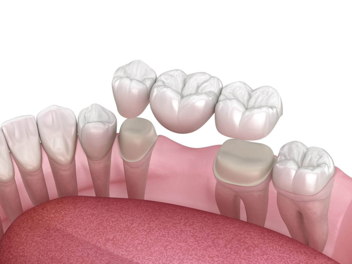 What Are the Benefits of Getting A Dental Bridge?