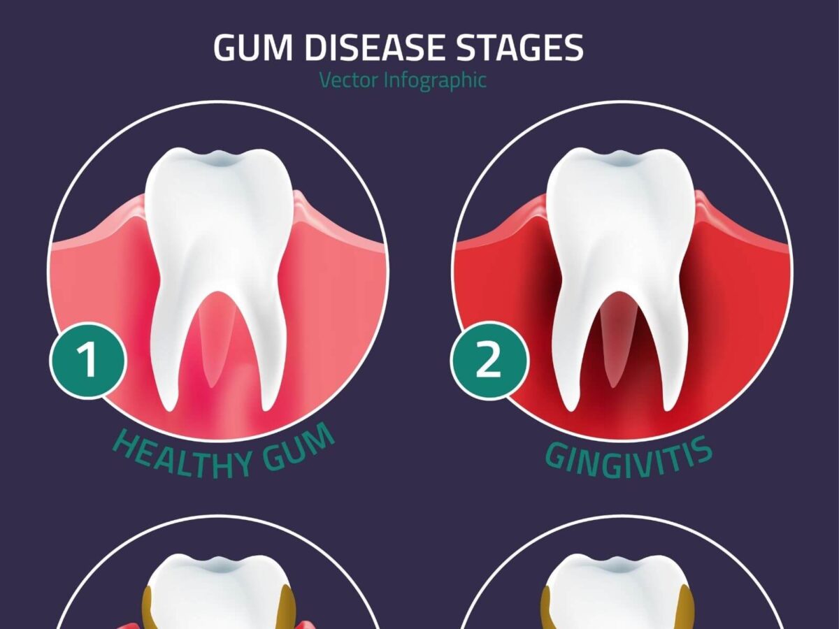 Everything You Need To Know About Gum Disease
