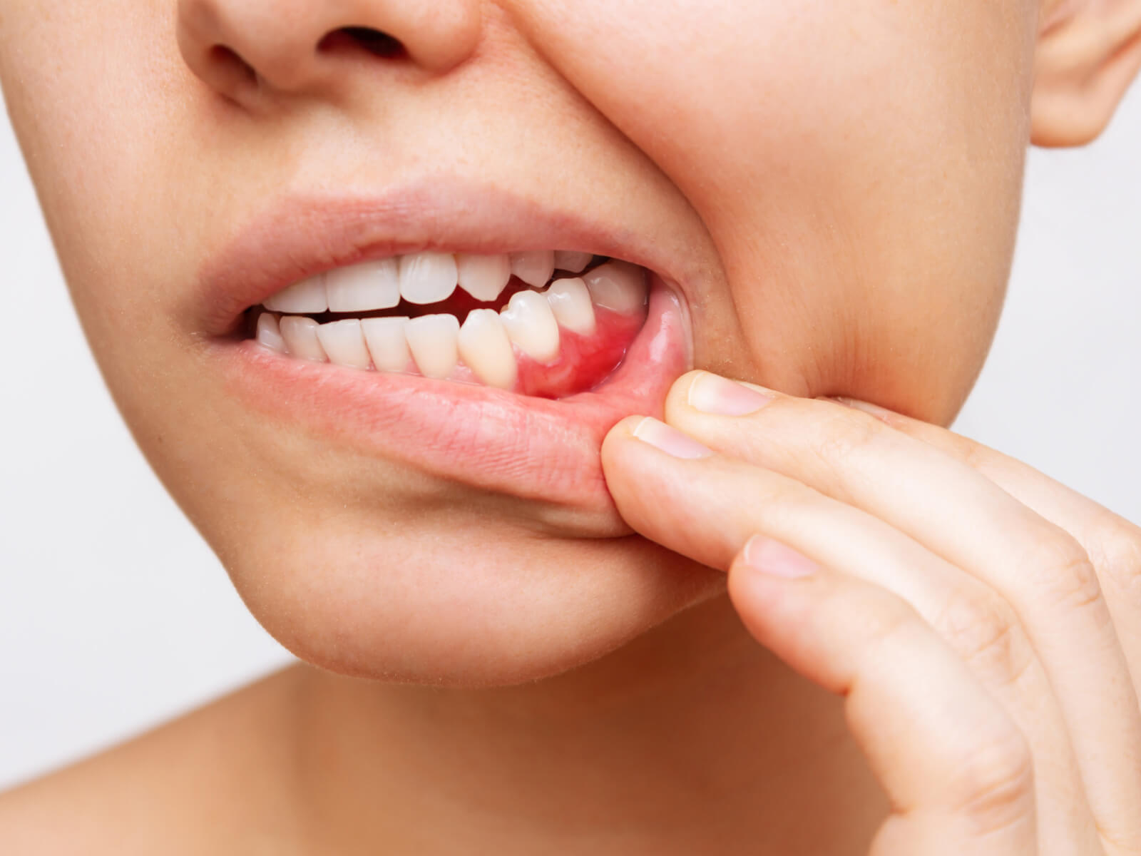 How Gum Disease Causes Bone Loss Around Your Teeth