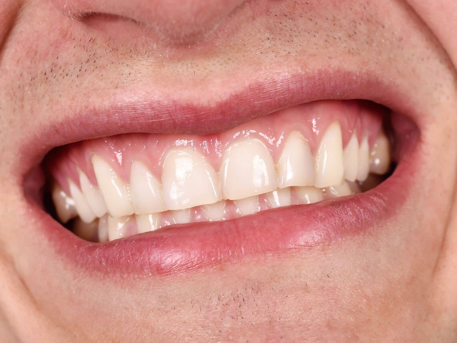 Types of Gum Infections and How They’re Treated