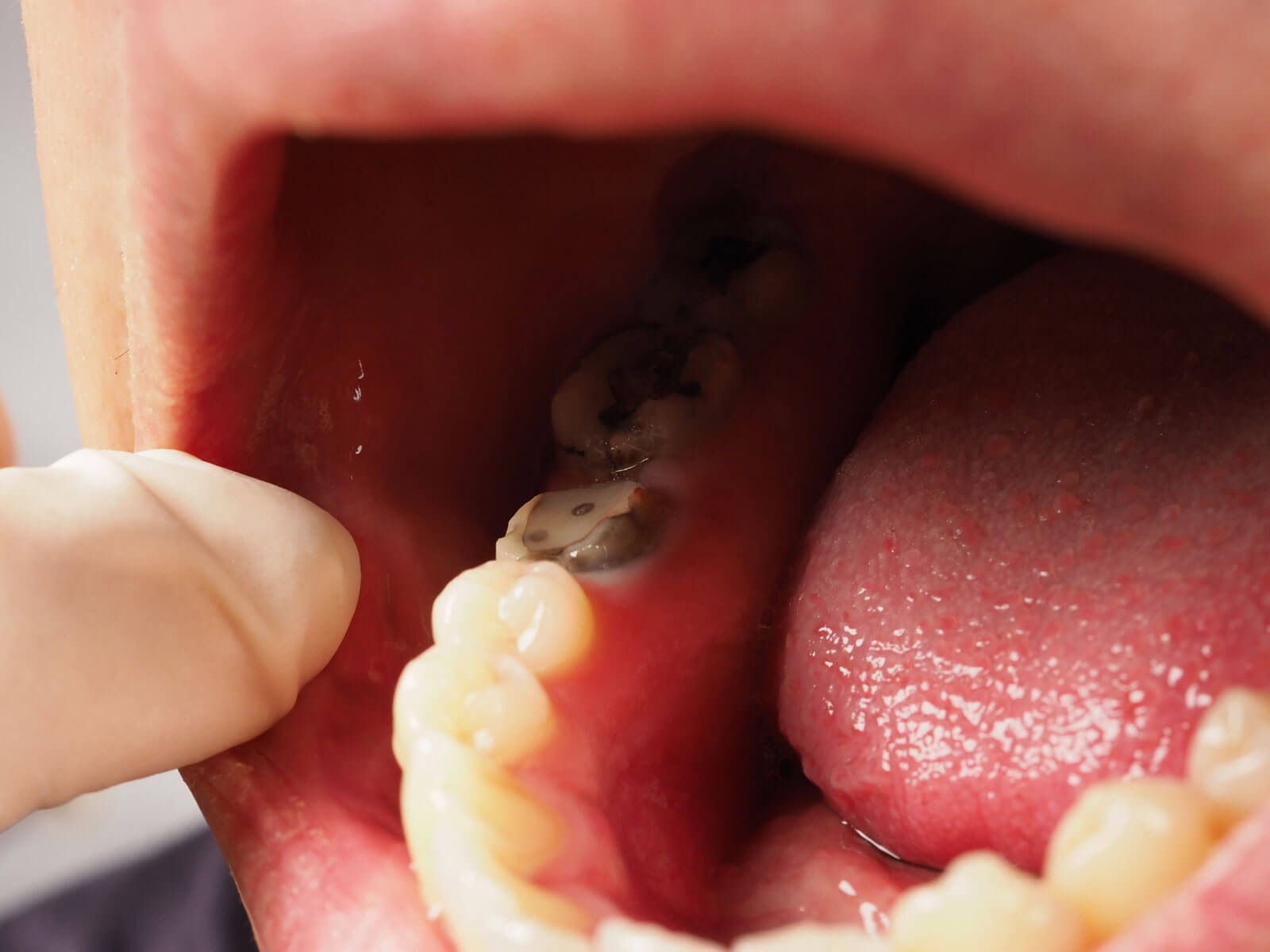 What Does a Decayed Tooth Look Like?