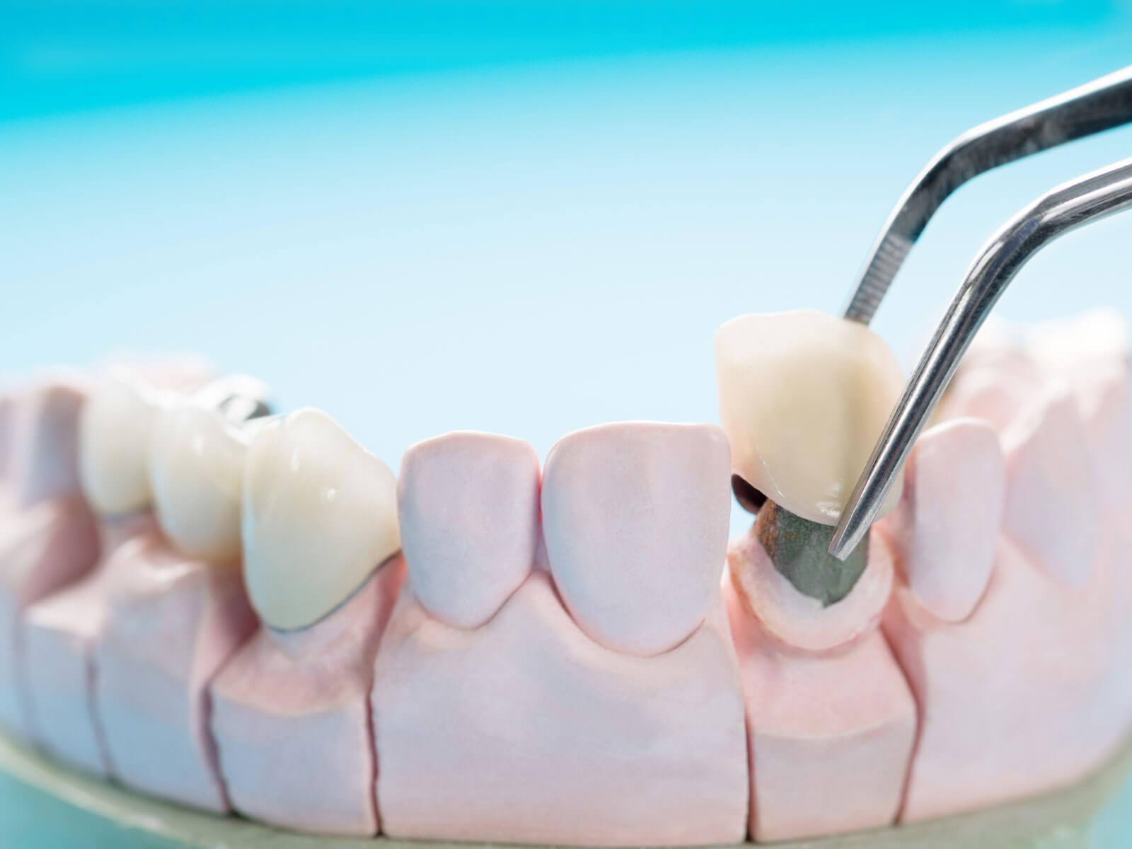 Dental Crown Cost: What Influences the Price?