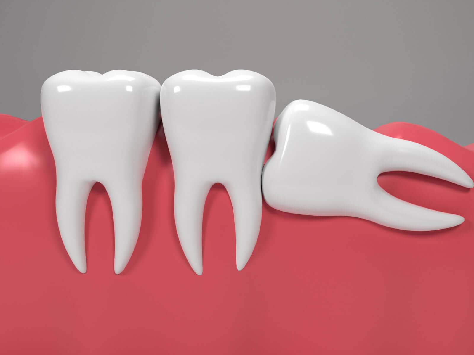 Wisdom Tooth Removal Recovery: Day-by-Day Timeline