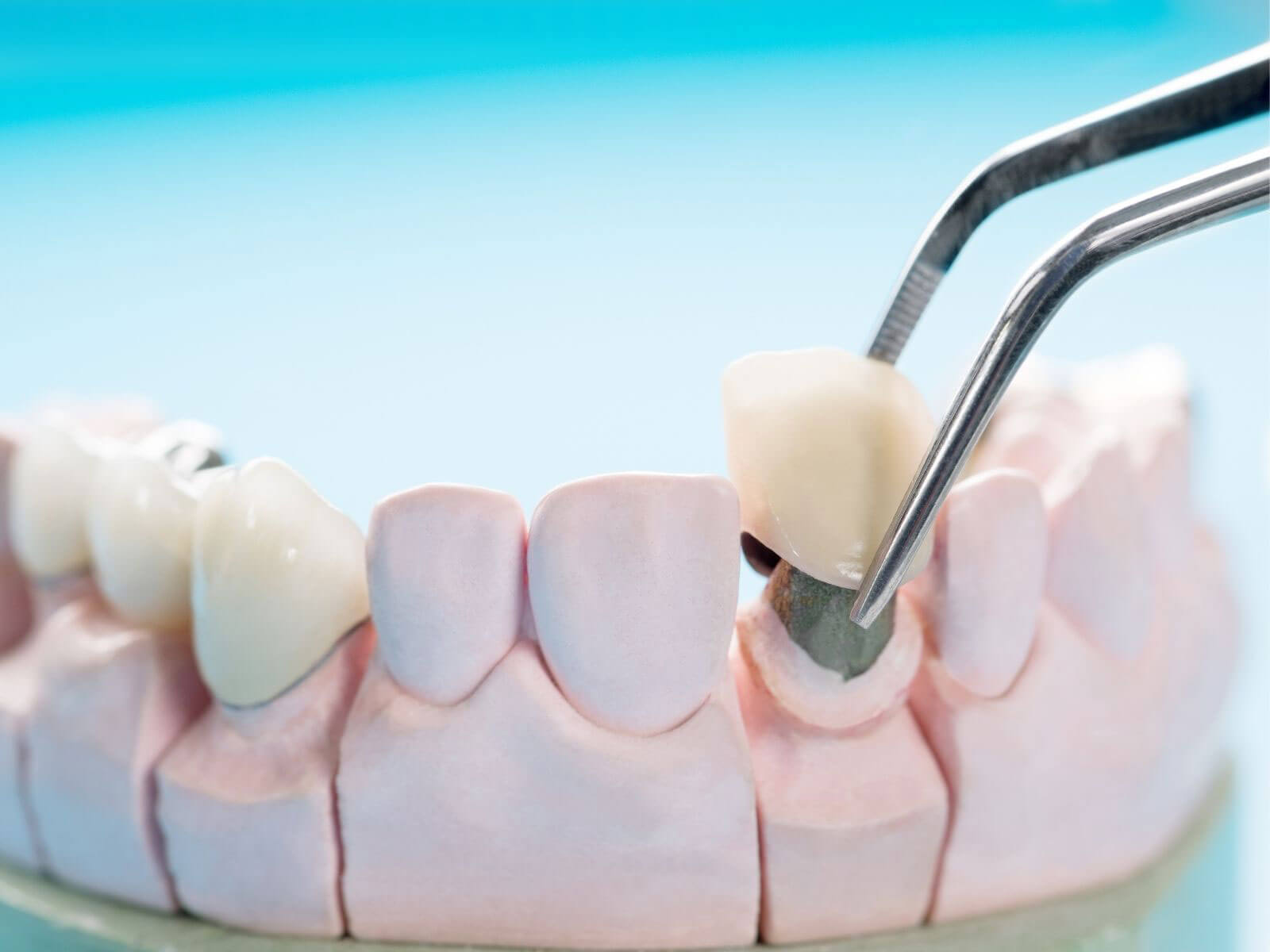 How Long Do Dental Crowns Last? Lifespan by Material and Care Tips