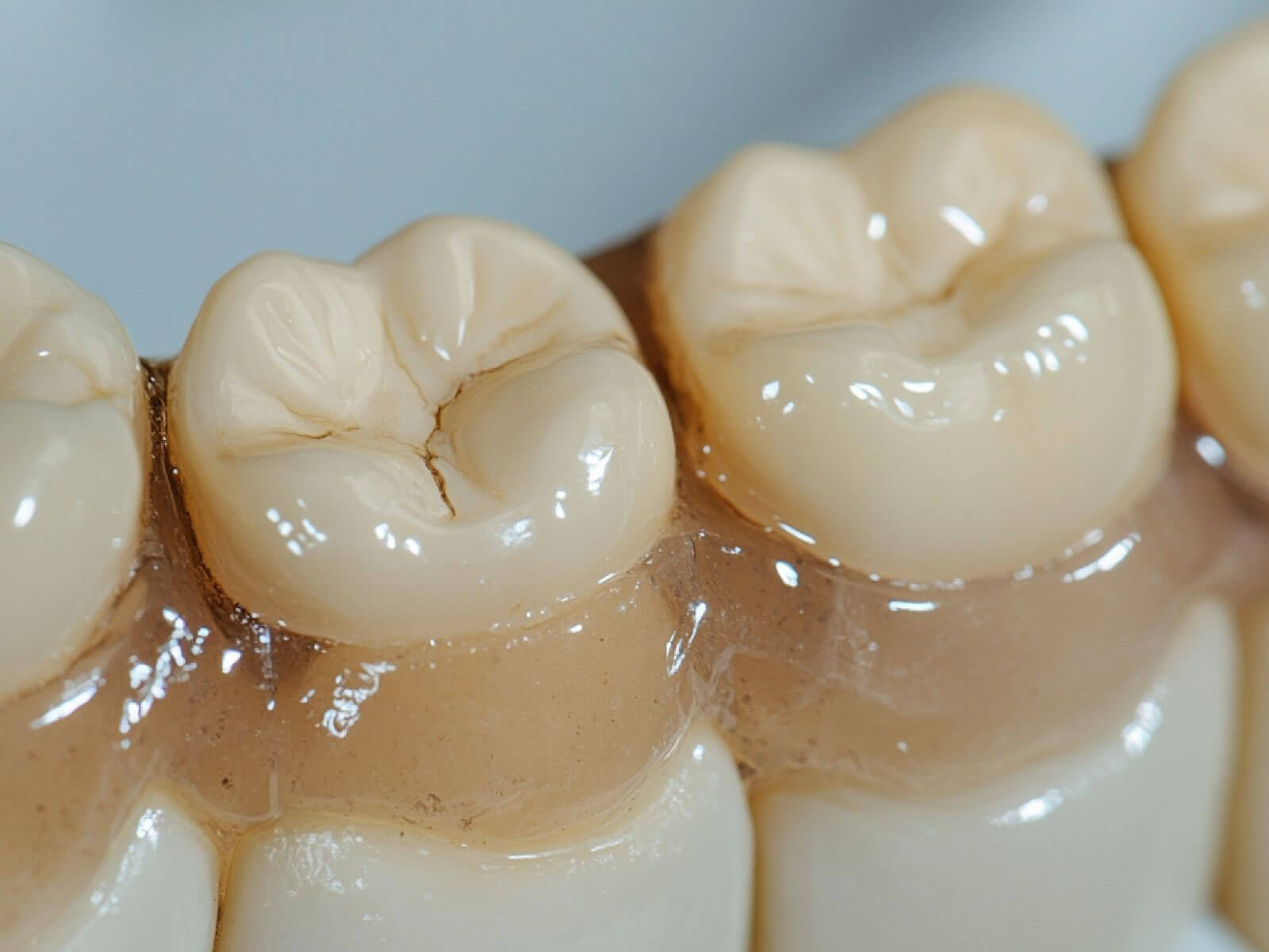 What Are Dental Sealants? How They Work, Benefits, and Costs