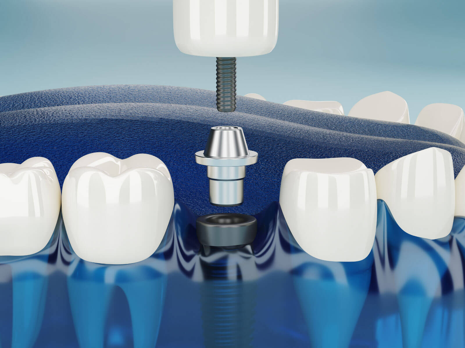 What Are Screwless Dental Implants? How They Work, Benefits, and Drawbacks