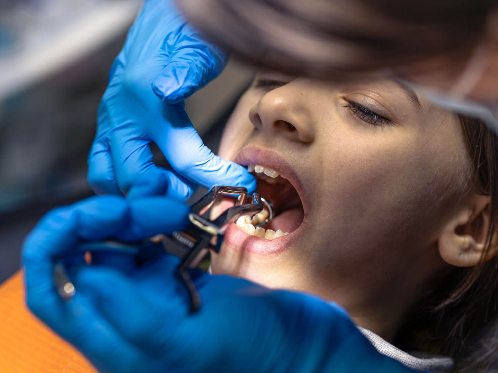 What Is an Avulsed Tooth? Causes and Emergency Care Steps